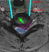 CervicalDiscectomy3png