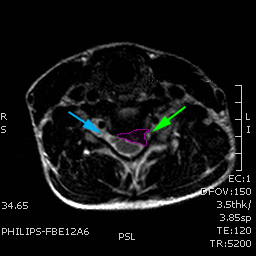 CervicalHernia