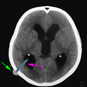 Hydrocephalus6