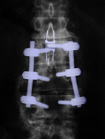 LumbarFusionDecompr
