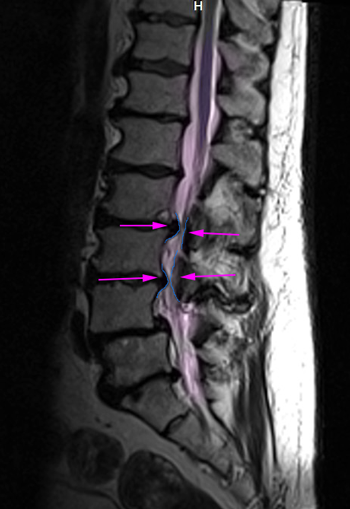 SpinalStenosis2