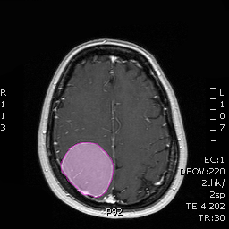 Meningioma2