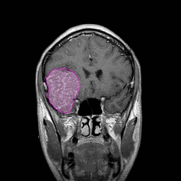 Meningioma4