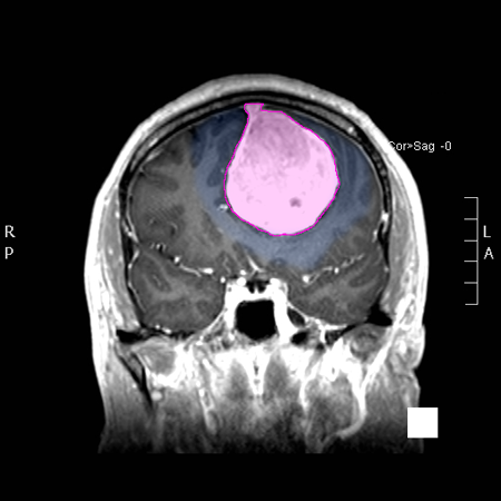 Meningioma6