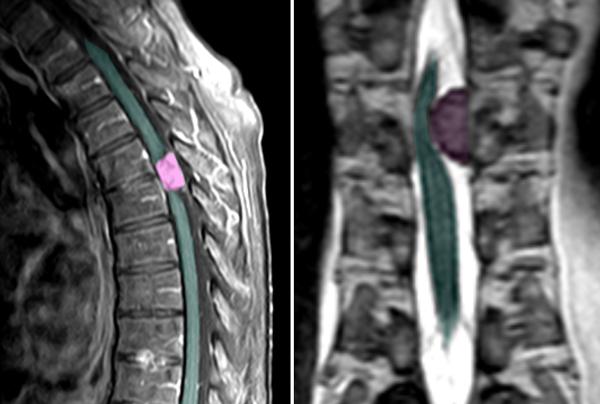 Meningeom im Spinalkanal MRTpng