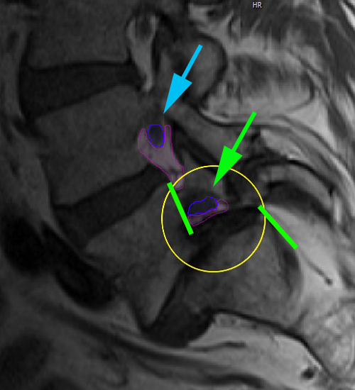 Spondylolisthesis2