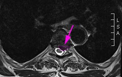 Thoracic-hernia