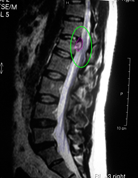 ThoracicHernia